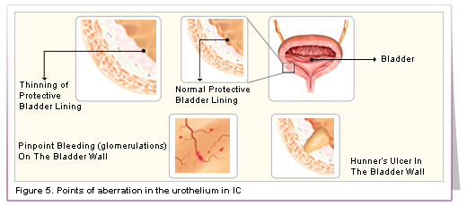 Points of aberration in the urothelium in IC